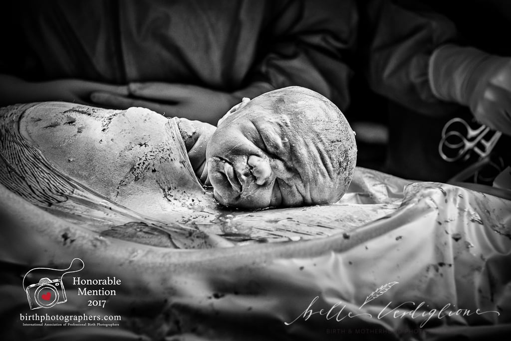 C-Section Mom Watching Baby's Birth