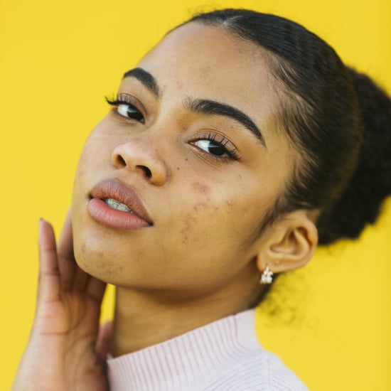 How to Identify Acne Types and Treat Them