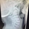 This X-Ray of a Grape Stuck in a Child's Throat Needs to Be Shared