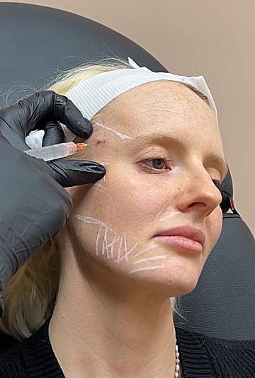 I Tried Sculptra: See Before and After Photos