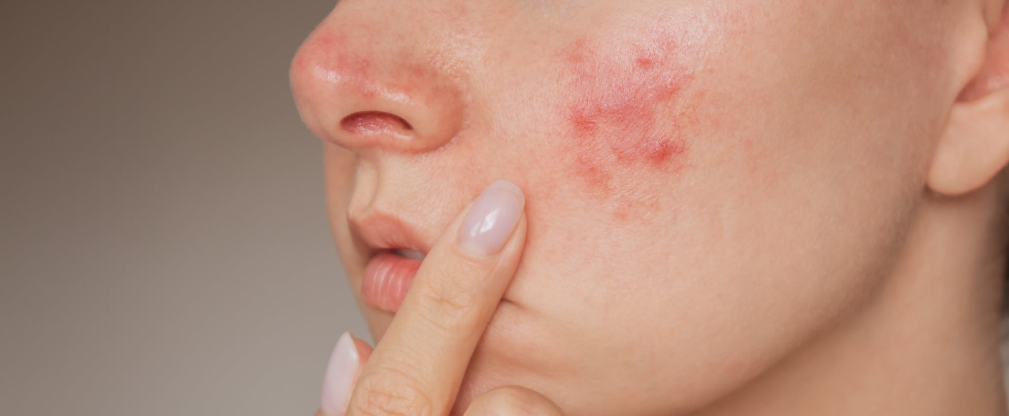 A Guide to Rosacea Symptoms, Triggers, and Treatments