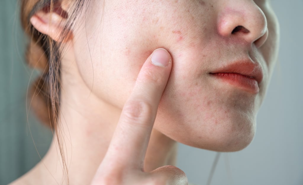 How to Treat Broken Capillaries on the Face