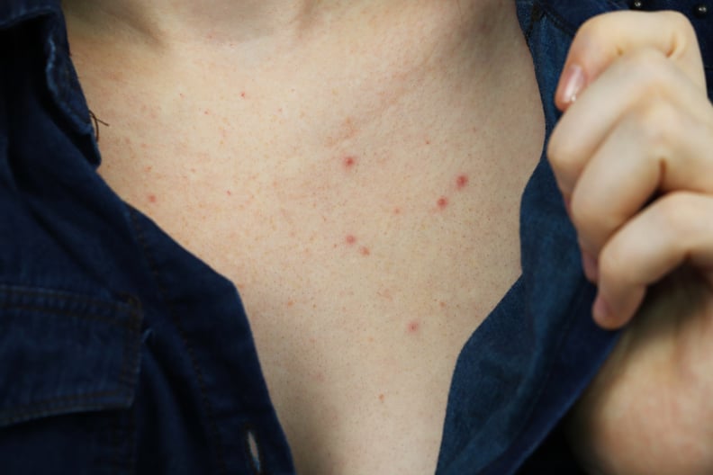white acne scars on chest