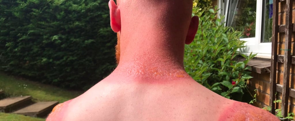 Viral Sunburn Tweet