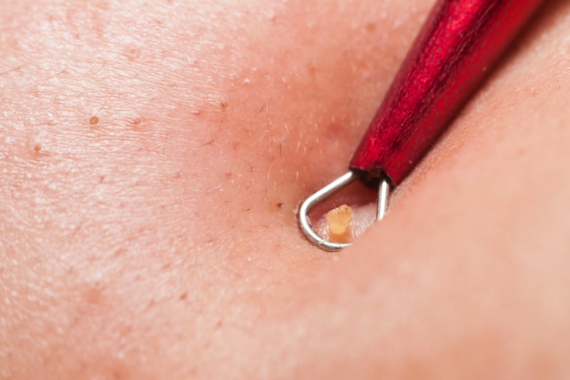 Pimple popping videos showcasing blackhead extractions are rising in popularity. Why?