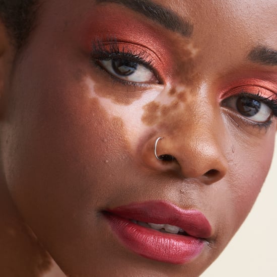 Vitiligo Skin Condition Causes and Treatments