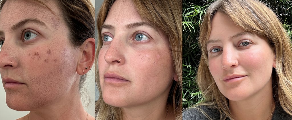 I Tried the Moxi Laser Treatment: See Photos