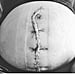 Why You Shouldn't Judge Moms Who Had C-Sections