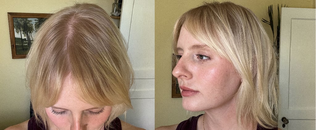 I Got PRP Injections For Hair Loss — and They Actually Worked