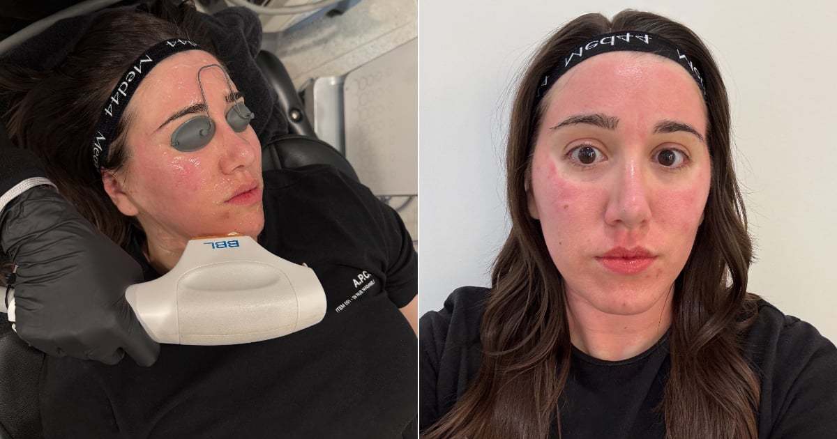 I Tried Laser Layering For My Dark Spots and Rosacea