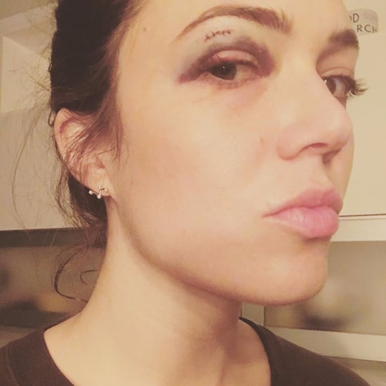 Mandy Moore Black Eye Photo on Instagram