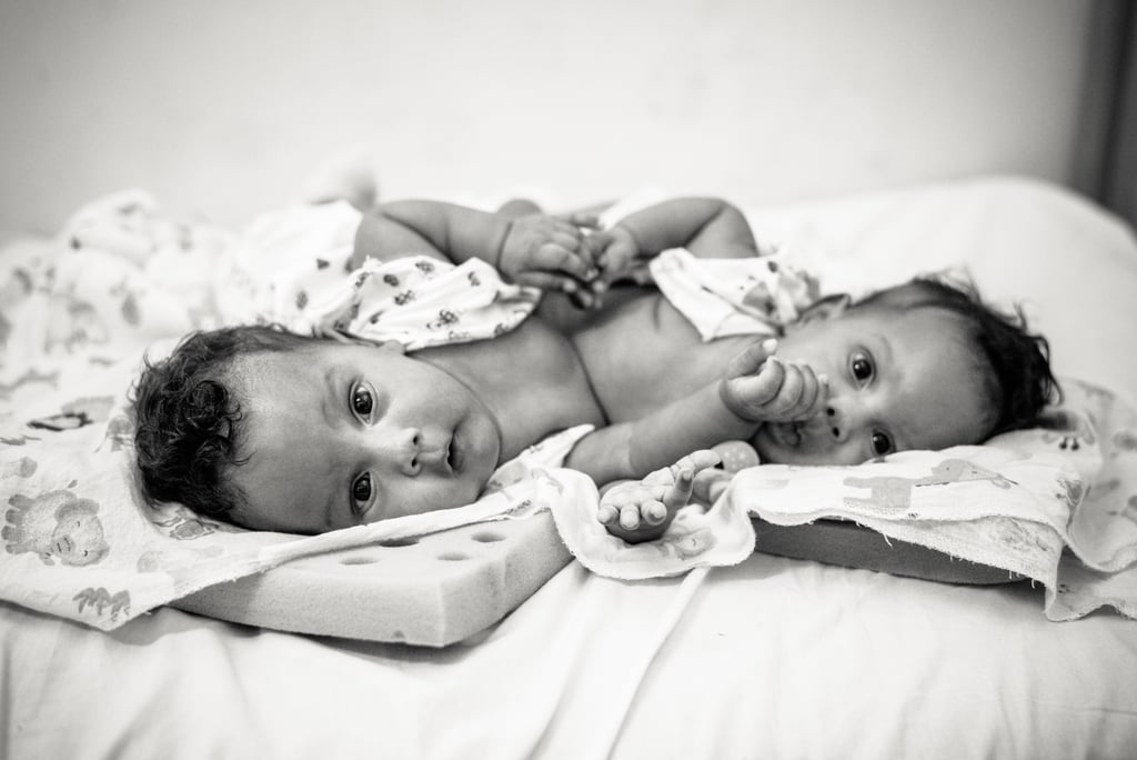 Photographer Captures the Beauty of Conjoined Twins