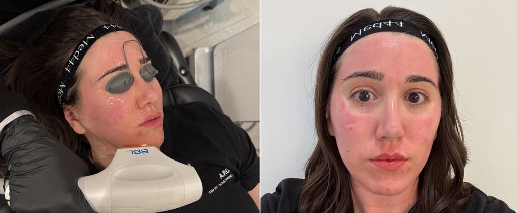 I Tried Laser Layering: See My Before and After Photos