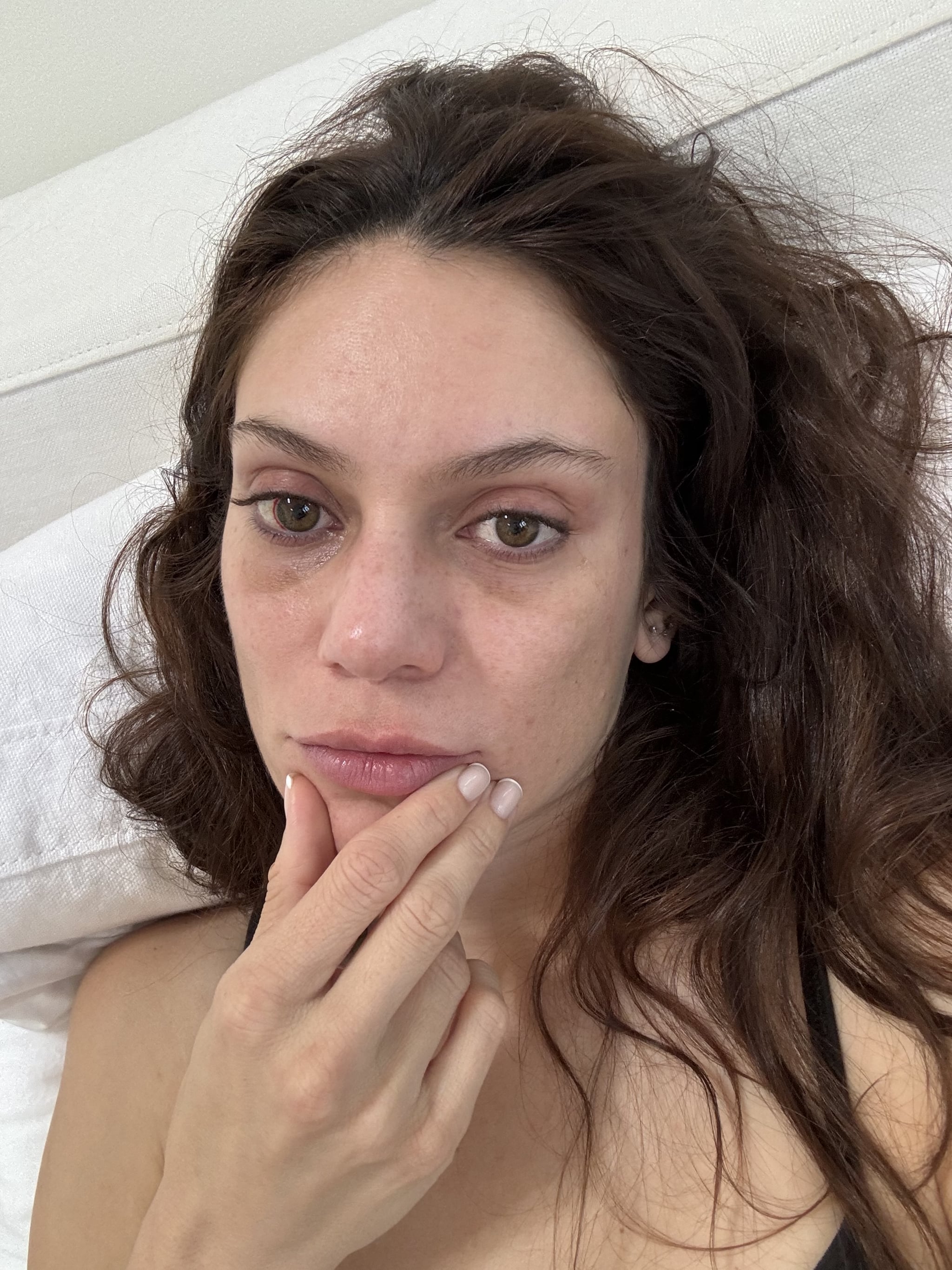 Residual bruising after brow lift surgery