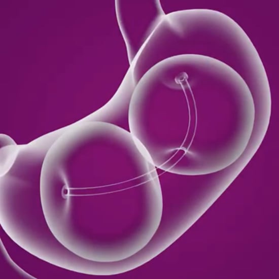 What Is a Gastric Balloon?