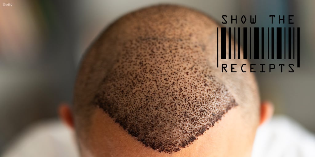 The $10,864 Cost of Getting a Hair Transplant