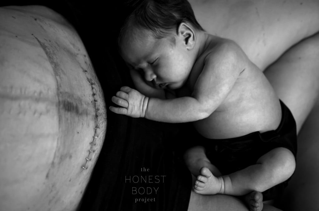 Honest Body Project Stapled C-Section Scar Photo Shoot