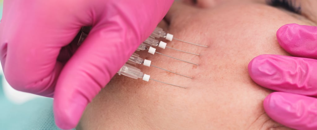 What Are Thread Lifts?