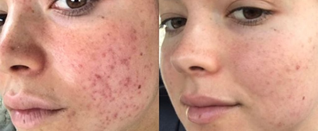Bekah Martinez Shares Her Acne Journey on Instagram