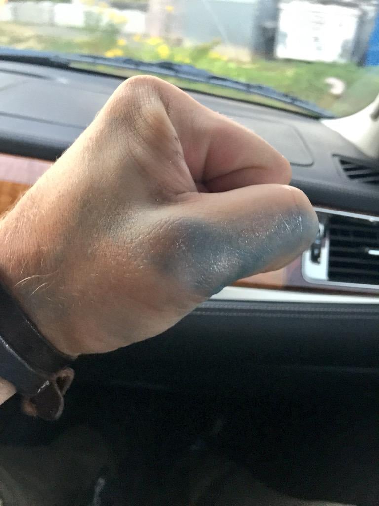 "These aren't bruises," Amell captioned on Twitter. "They're better."