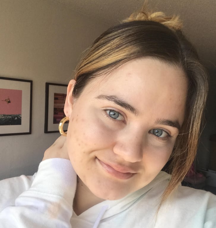 Editor Acne Confessions Personal Experiences With Breakouts Popsugar Beauty Editor Acne Confessions Personal Experiences With Breakouts Popsugar Beauty