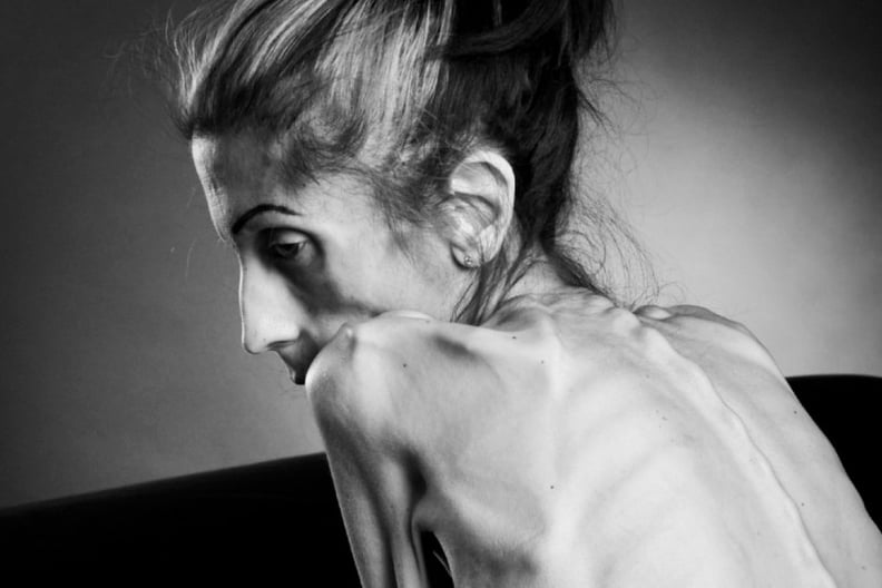 When a Woman Beat Anorexia with the Support of Thousands