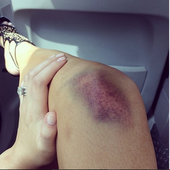 Chrissy Teigen Gets Bruise From Muay Thai Boxing