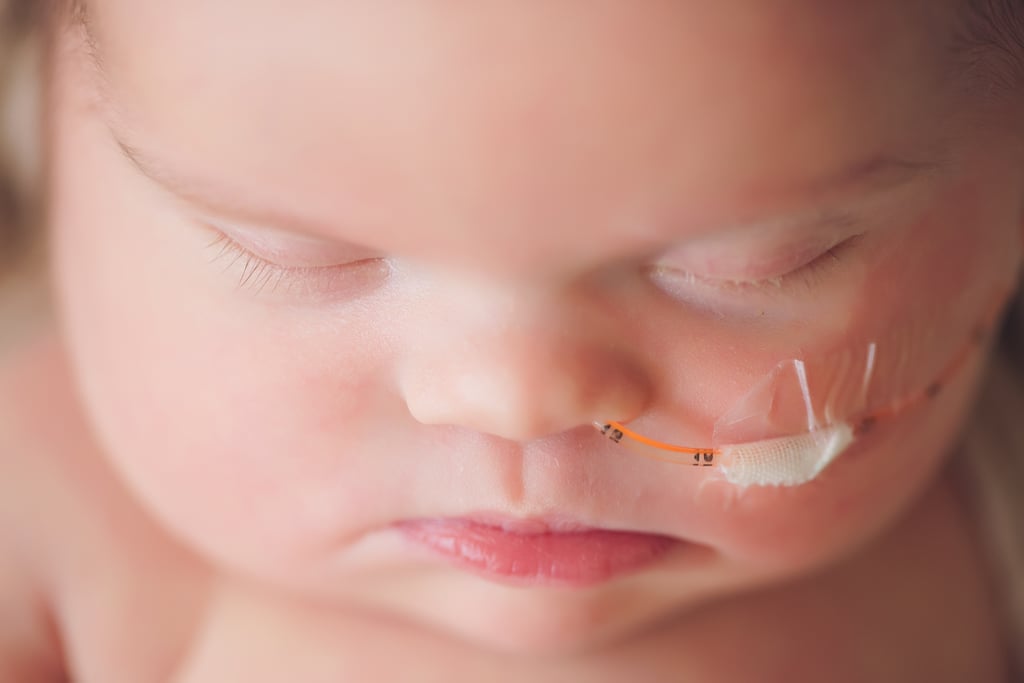 Newborn With Inoperable Tumor in Family Photos