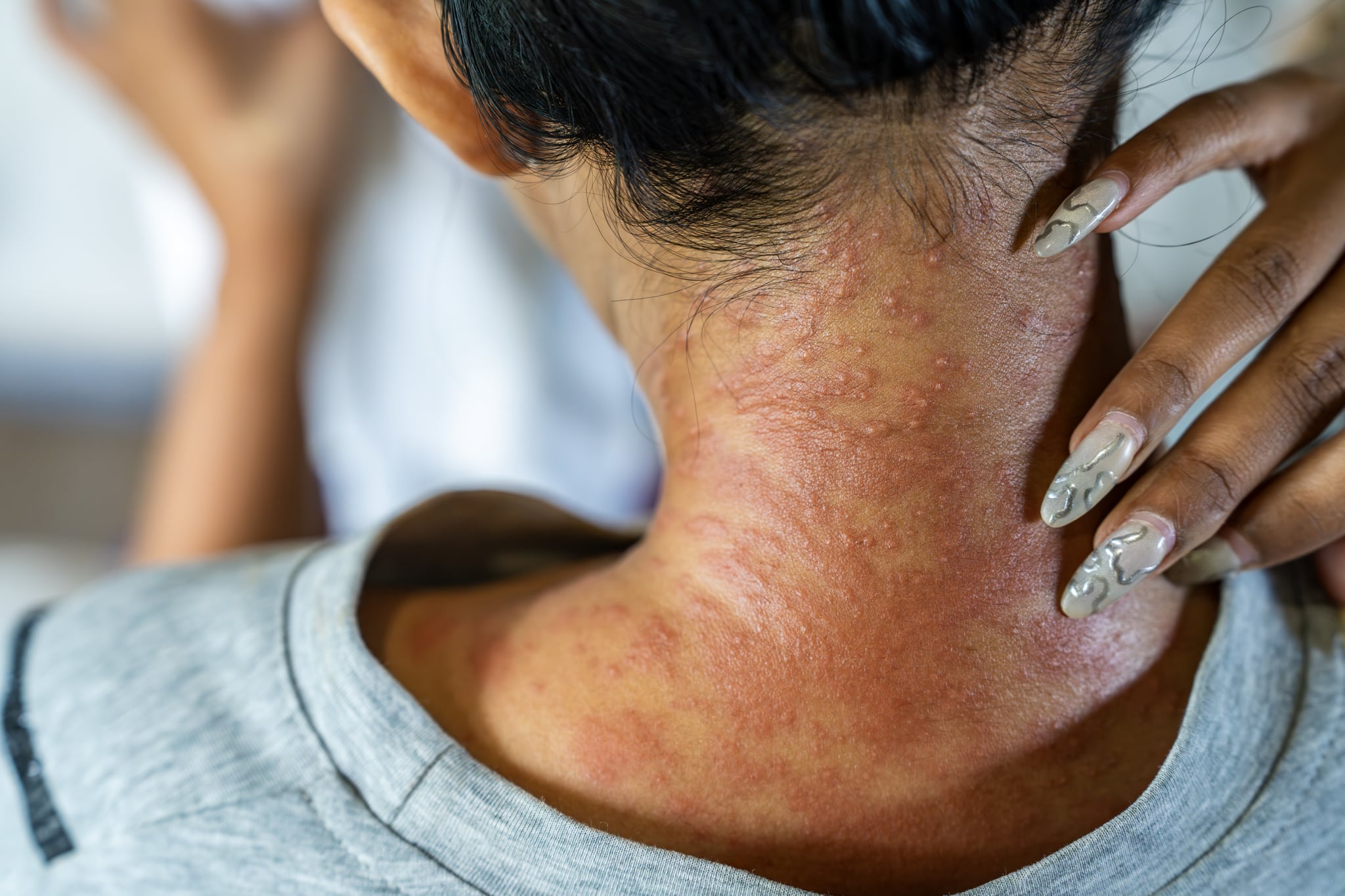 Close-up of a woman scratching an itchy rash on her neck, likely caused by skin conditions such as eczema, highlighting the discomfort and inflammation of sensitive skin