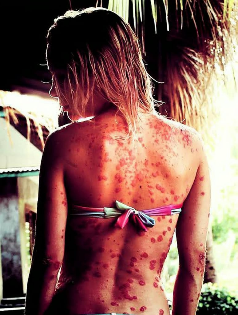 Model With Psoriasis | Psoriasis Pictures