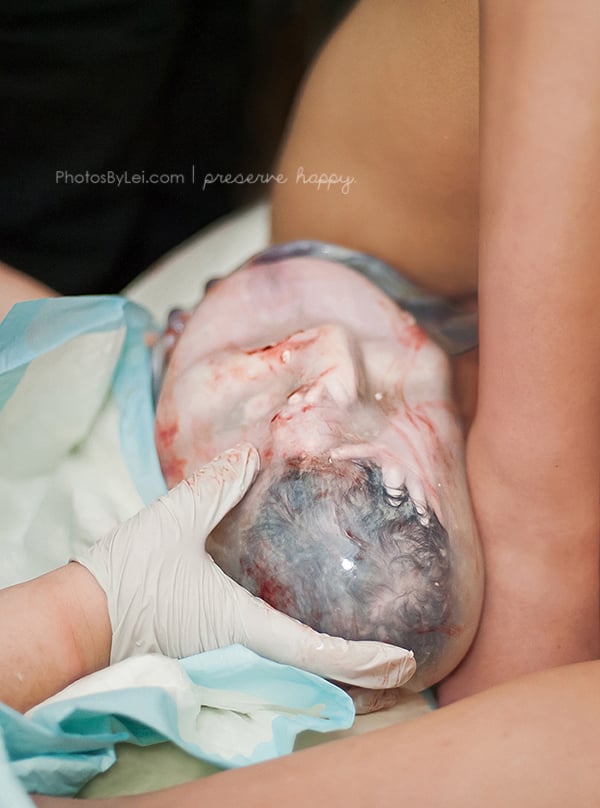 One of the twin newborns still inside its amniotic sac.