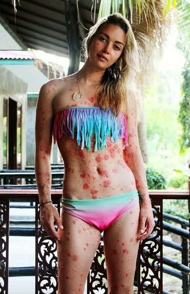 Model With Psoriasis | Psoriasis Pictures