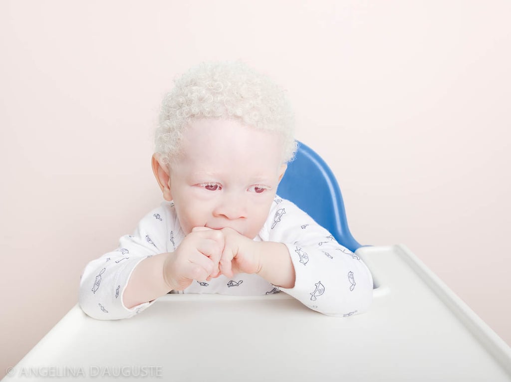 Albinism Photographs