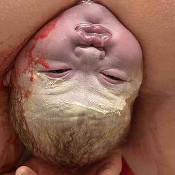 Birth Photograph Removed From Facebook