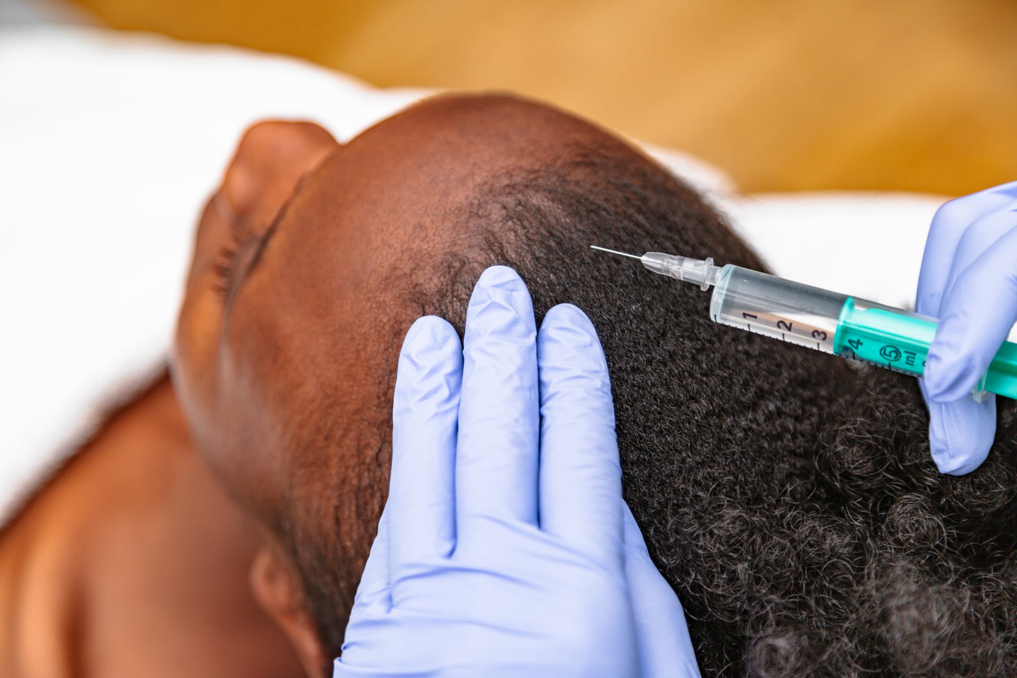 Women gets Botox injections around hairline to preserve her edges