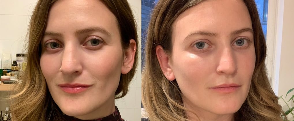 Undereye Filler Before and After