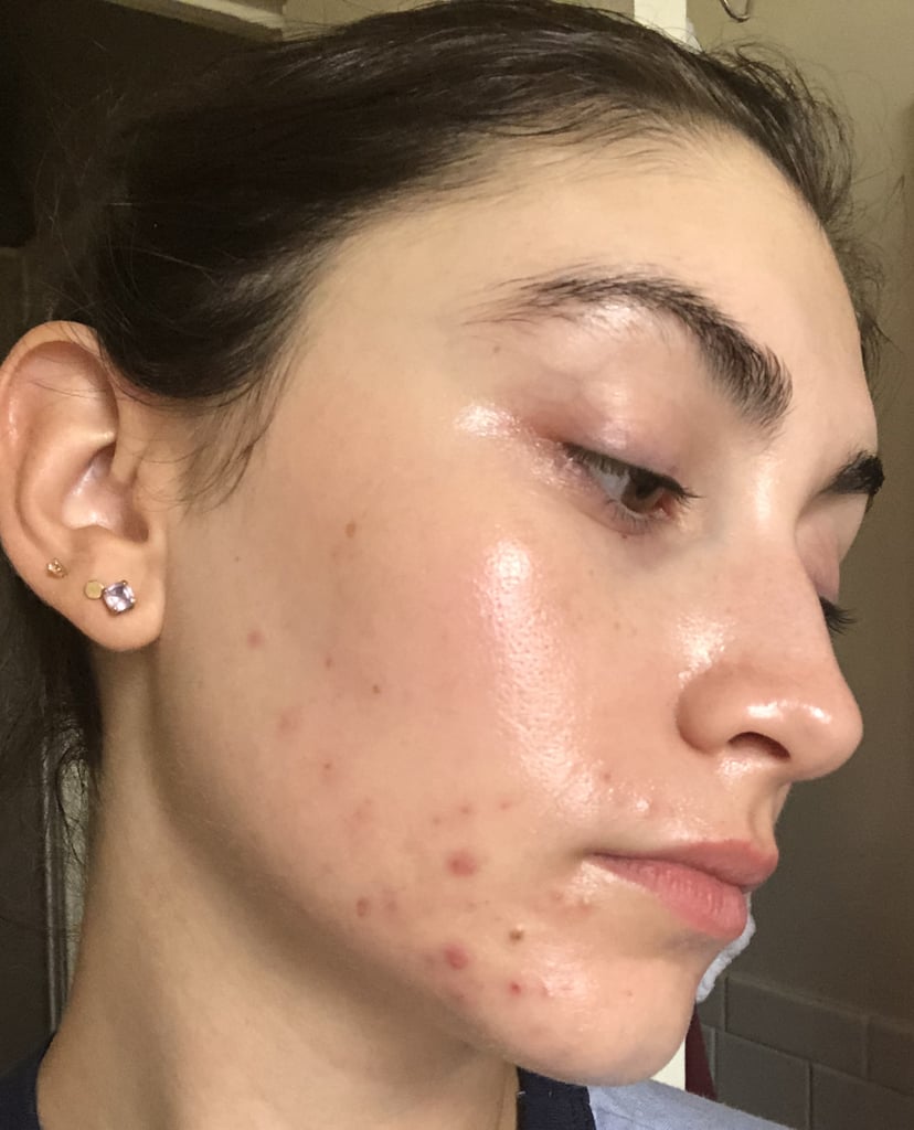 My Personal Journey Taking Spironolactone For Acne | POPSUGAR Beauty UK