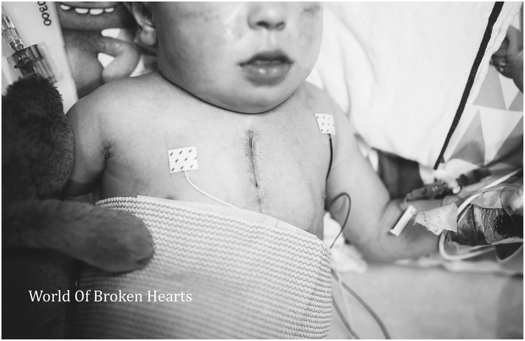 Toddler Born With Heart Defect Dies Waiting For Transplant