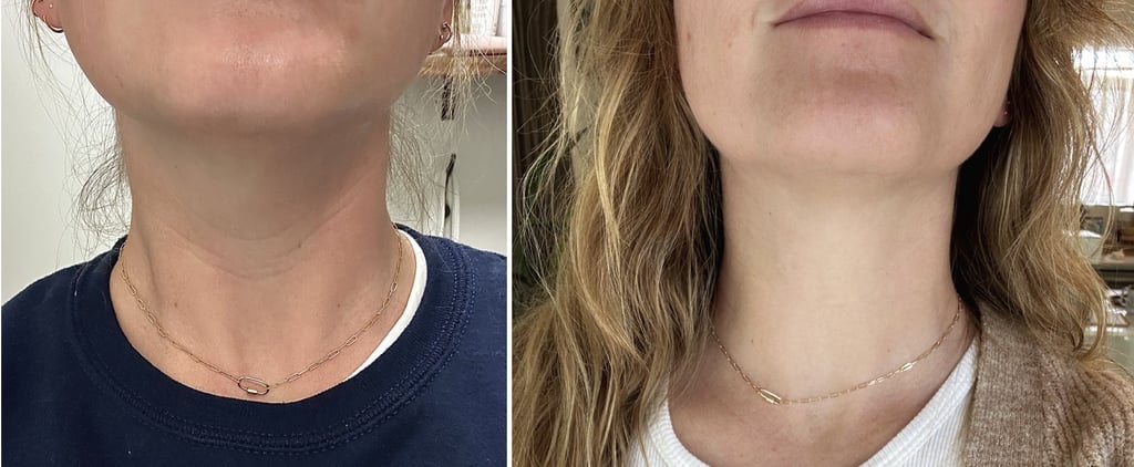 I Got Neck Botox: See Before and After Photos