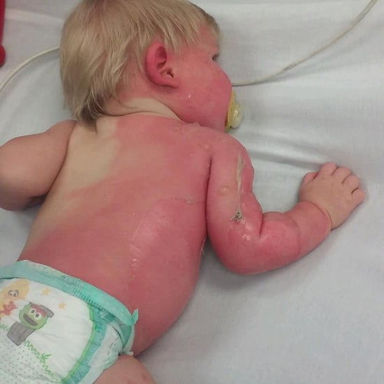 Little Boy Burned by Garden Hose
