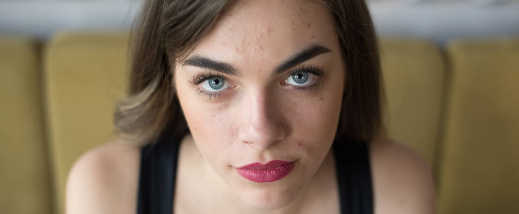 Read This Before You Start a Prescription-Strength Acne Product