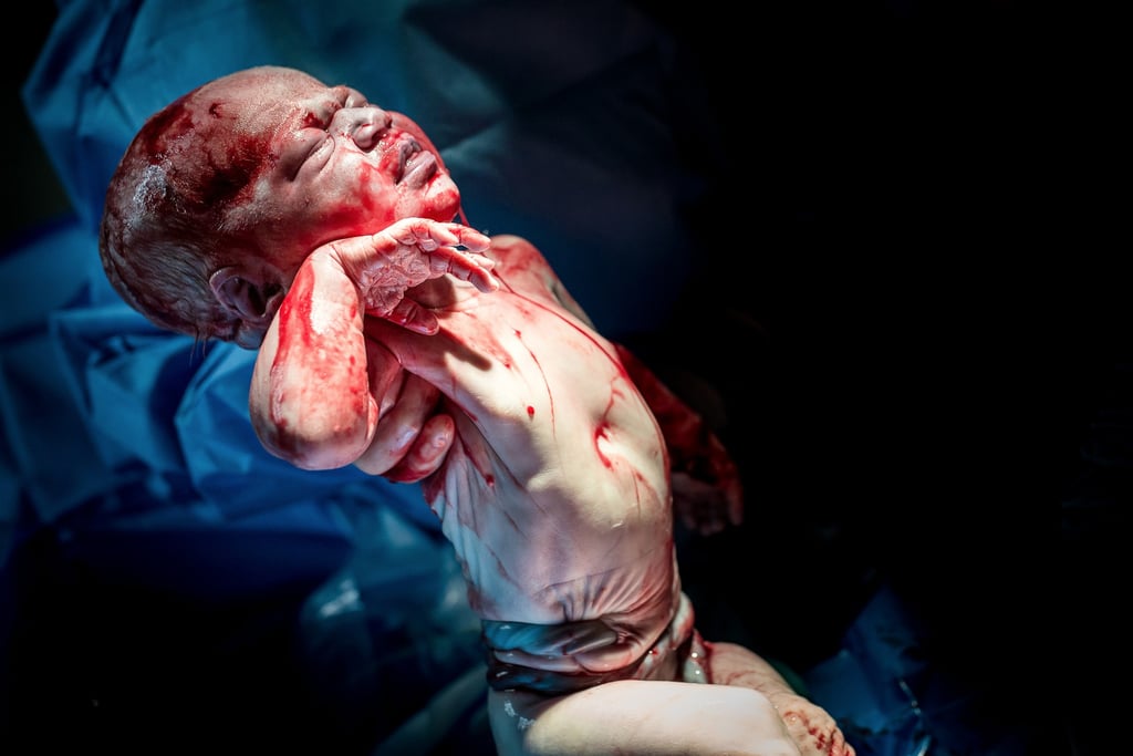 Baby Born With Umbilical Cord Wrapped Around Her Stomach