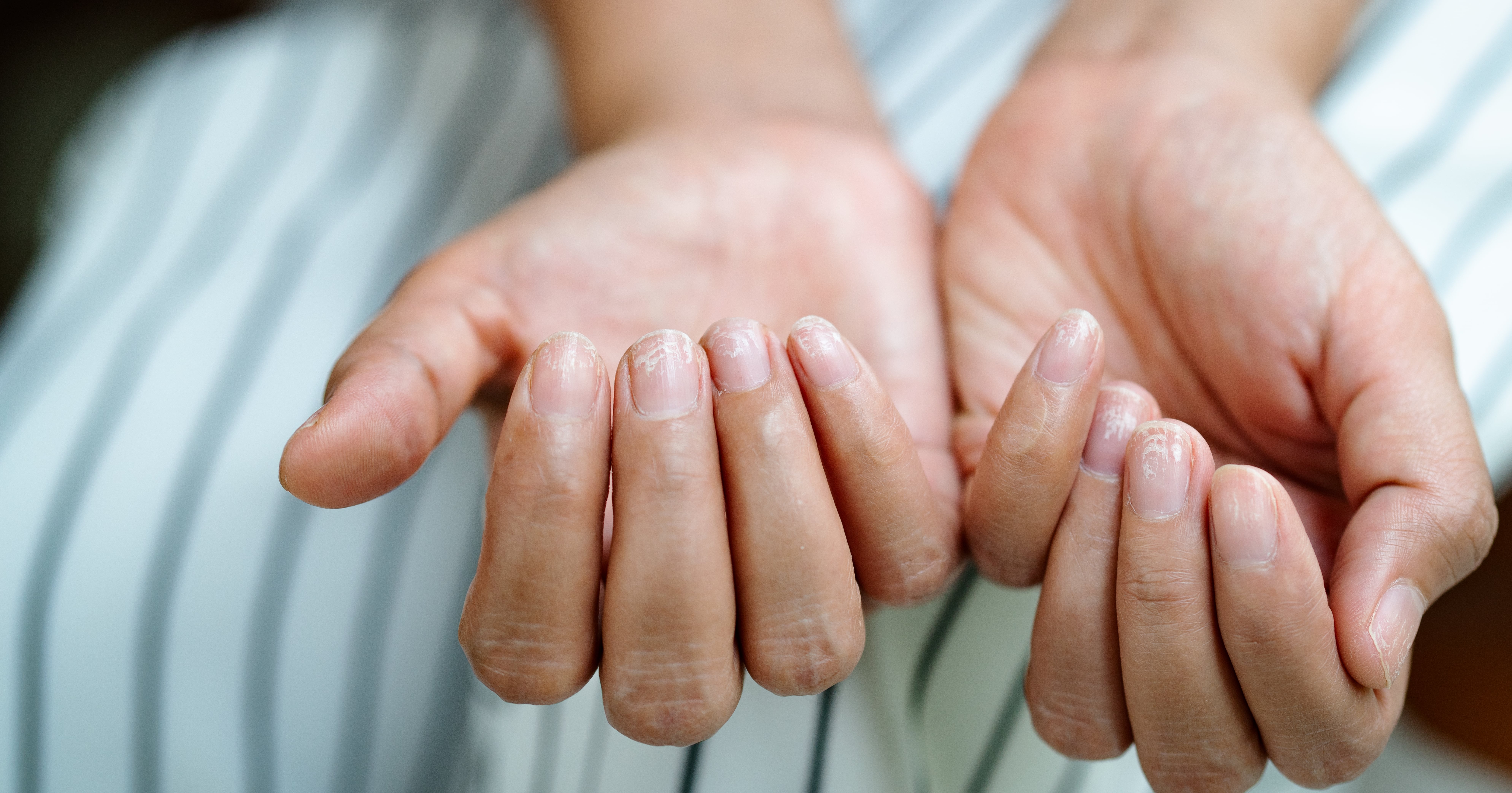 Why Are My Nails Peeling? 2 Experts Weigh In