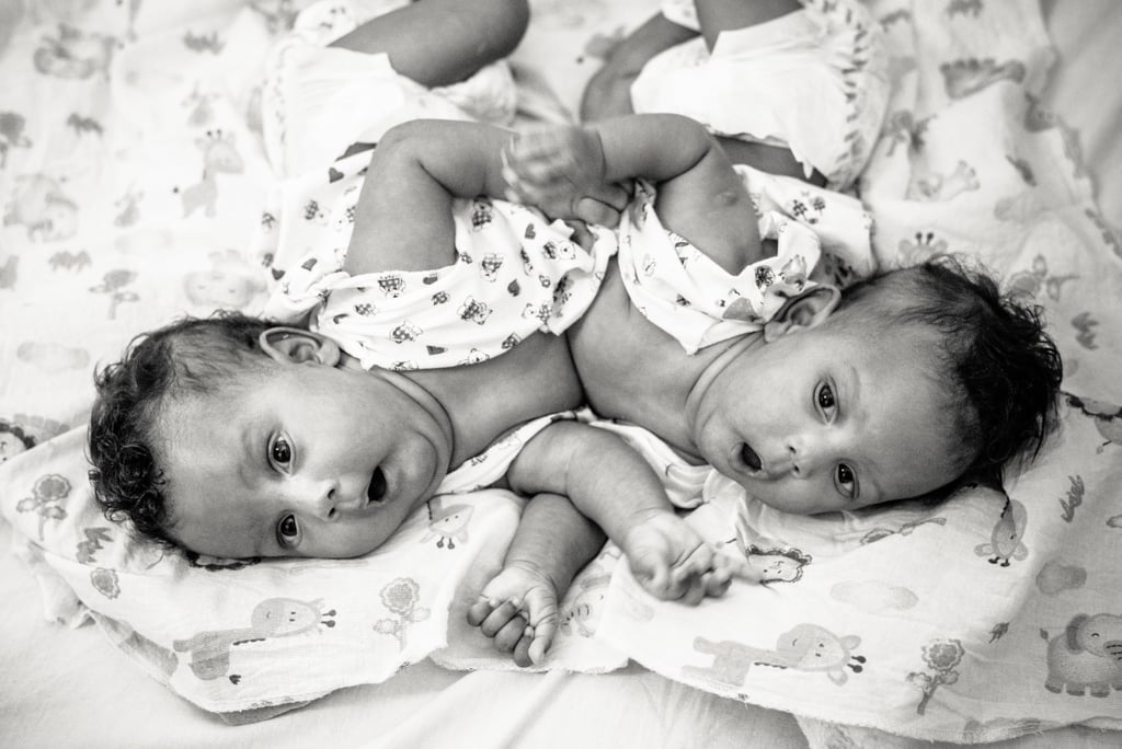 Photographer Captures the Beauty of Conjoined Twins