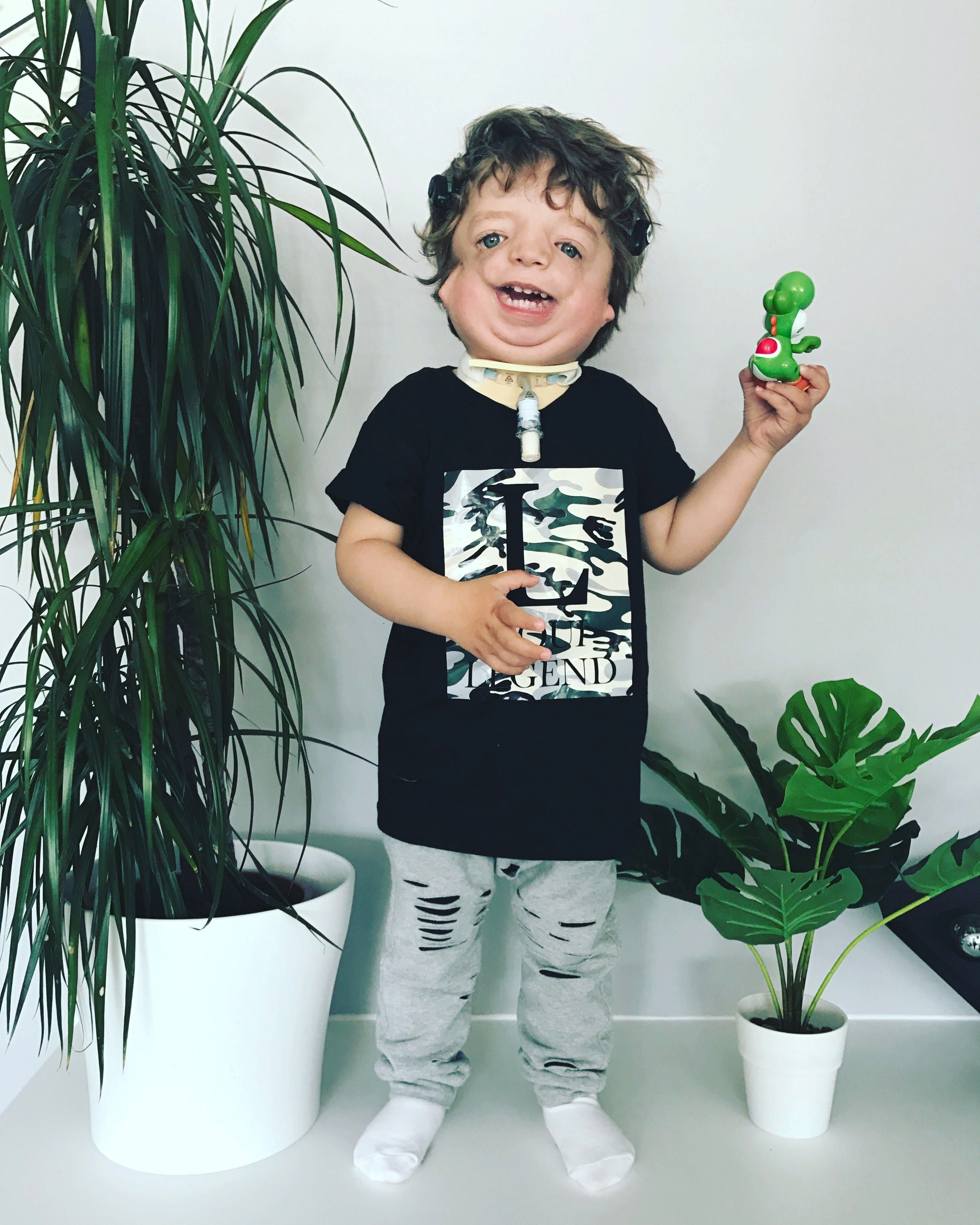 Baby Model With Facial Deformity | PS Family