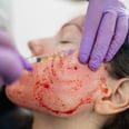 Multiple People Have Been Diagnosed With HIV After Getting a "Vampire Facial"