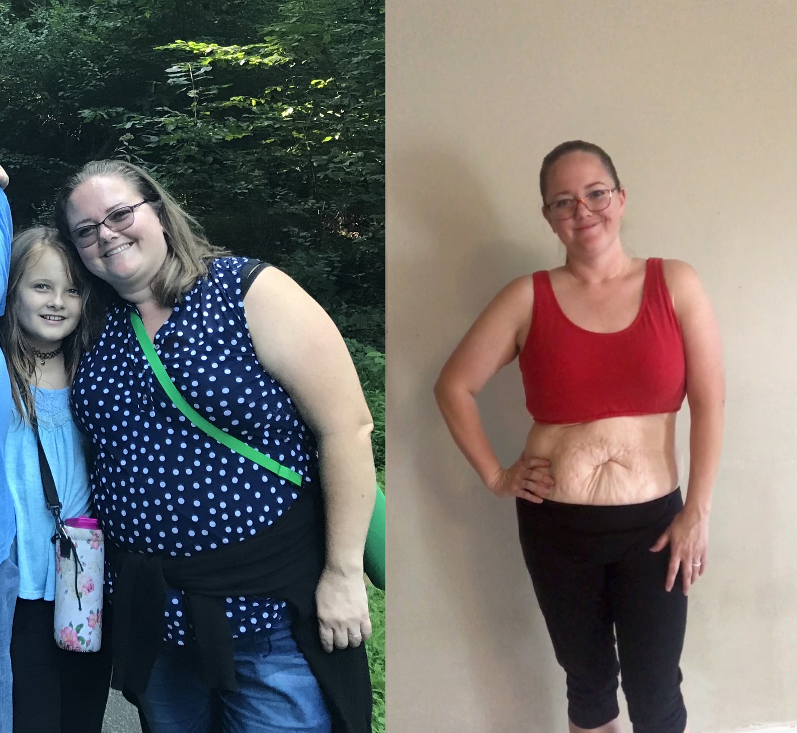 personal-essay-on-loose-skin-from-weight-loss-popsugar-fitness