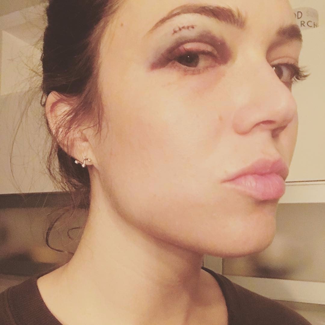 Mandy Moore Black Eye Photo On Instagram Popsugar Celebrity