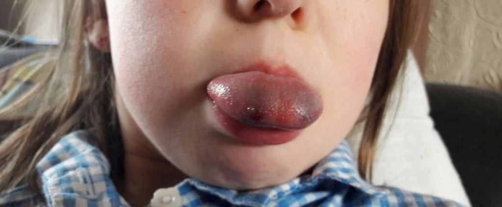 Disney Mug Lid Stuck on Girl's Tongue