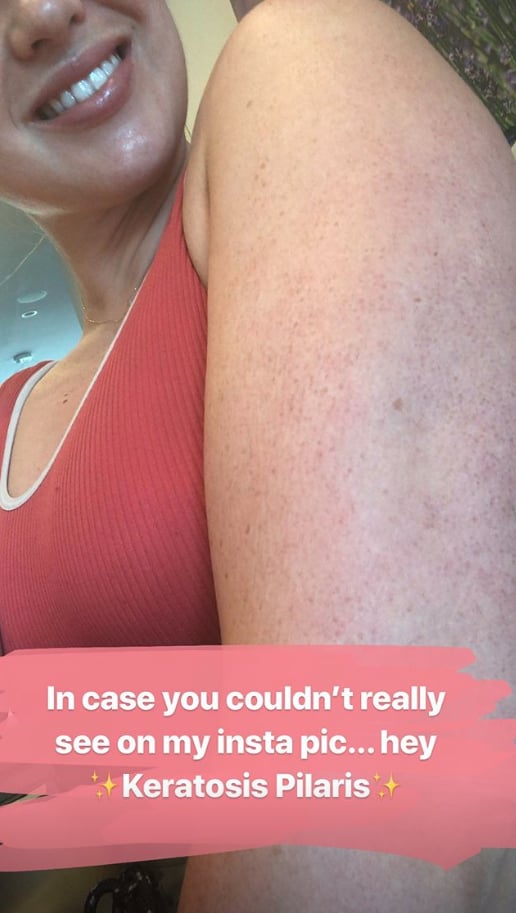 Iskra Lawrence Opens Up About Keratosis Pilaris On Instagram Popsugar Beauty Uk